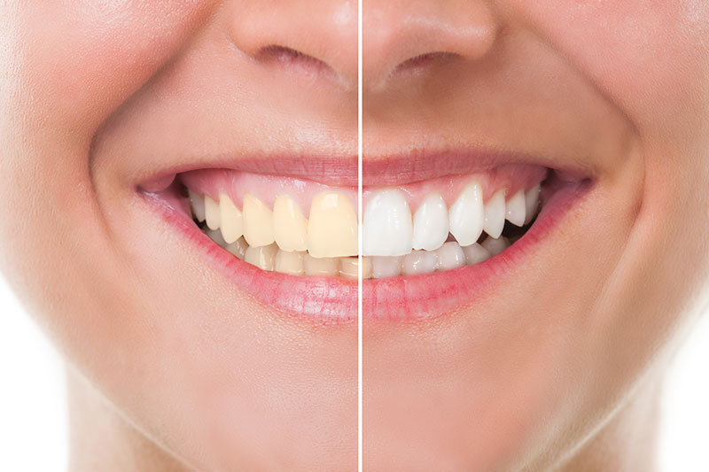 Teeth Whitening - PINE TREE DENTAL, Fayetteville Dentist